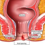 Fissure Treatment in Pune