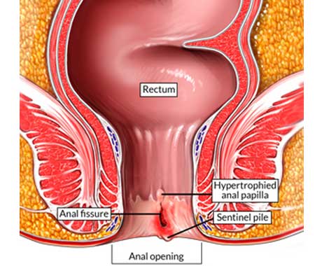 Fissure Treatment 1 Fissure Treatment in Pune