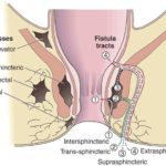 Perianal Abscess