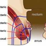 Anal Fistula ayurvedic kshar sutra treatment