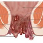 Piles Treatment in Pune