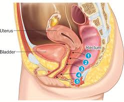 Recto Vaginal Fistula Treatment 1 Recto Vaginal Fistula Treatment