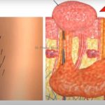 Pilonidal sinus Treatment