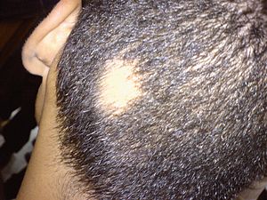 Hair fall Treatment