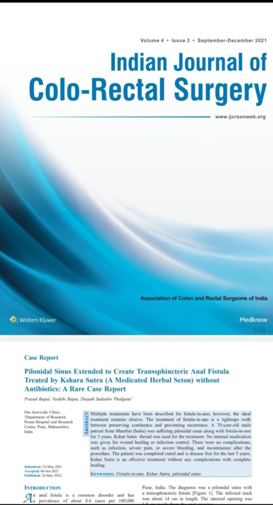Pilonidal Sinus + Complex Fistula Cured Without Antibiotics