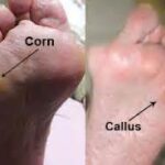 foot corn - Ayurvedic treatment without surgery