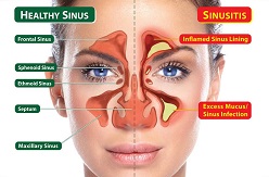 Ayurvedic Treatment for sinusitis
