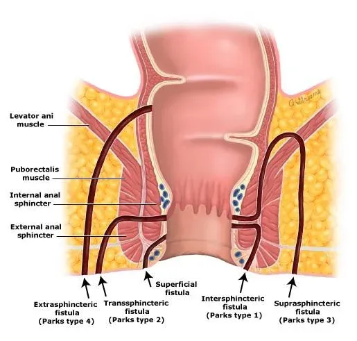 Anal fistula (fistula in ano) types